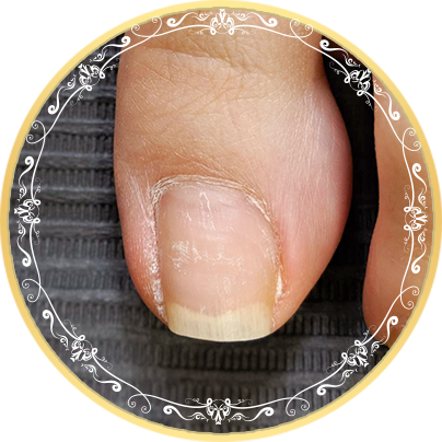足の困り爪の改善
